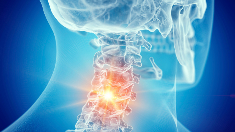 Cervical Spondylosis