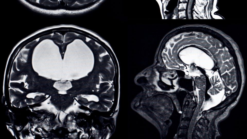 Hydrocephalus