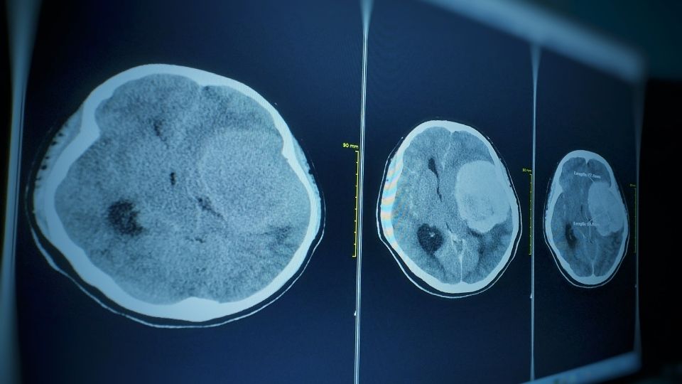 Meningiomas