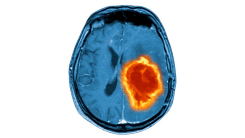 Metastatic Tumors