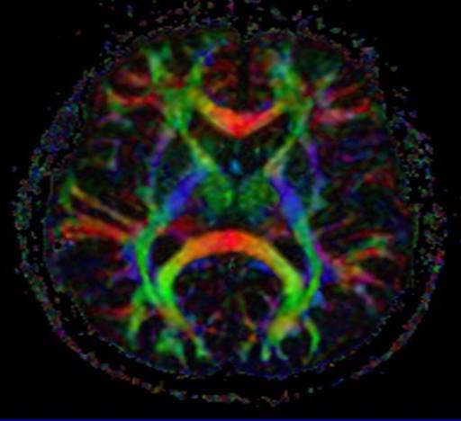 Tractography 1