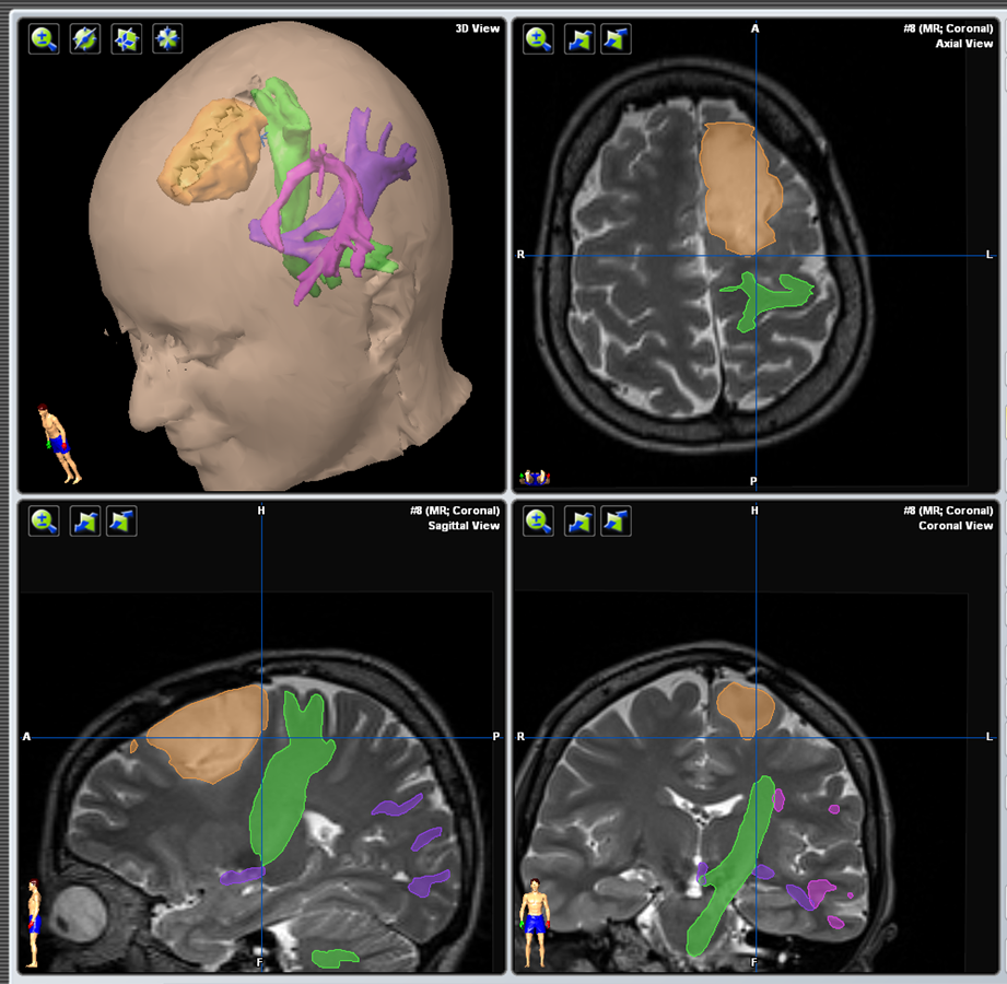 Tractography 2