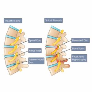 Lumbar Spinal Stenosis - Dr. Symeon Missios, MD