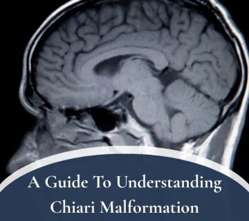 Chiari Malformation 360x320