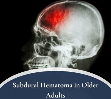 Subdural Hematoma in Older Adults 360x320