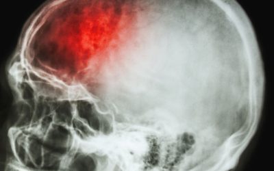 Time Is Brain: What the First Hours After a Stroke Actually Look Like