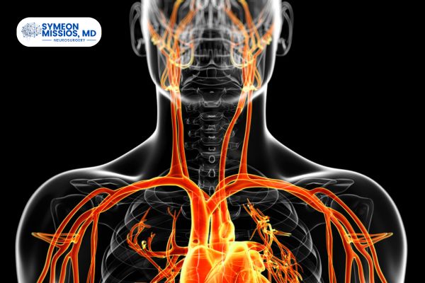 AVM & dAVF Embolization