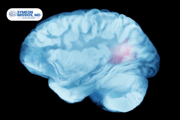 Acute Ischemic Stroke