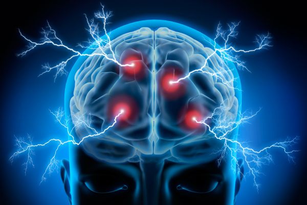 Aneurysm Coil Embolization