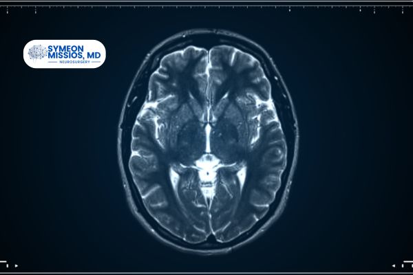 Arteriovenous Malformations (AVMs)