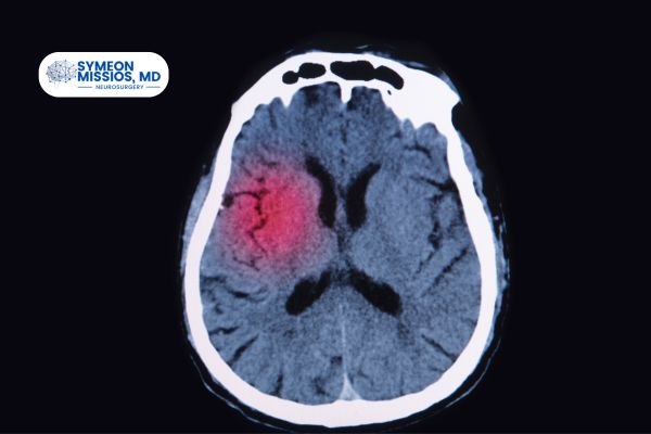 Brain Aneurysms