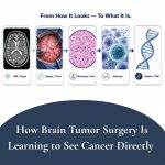 How Brain Tumor Surgery Is Learning to See Cancer Directly 150x150