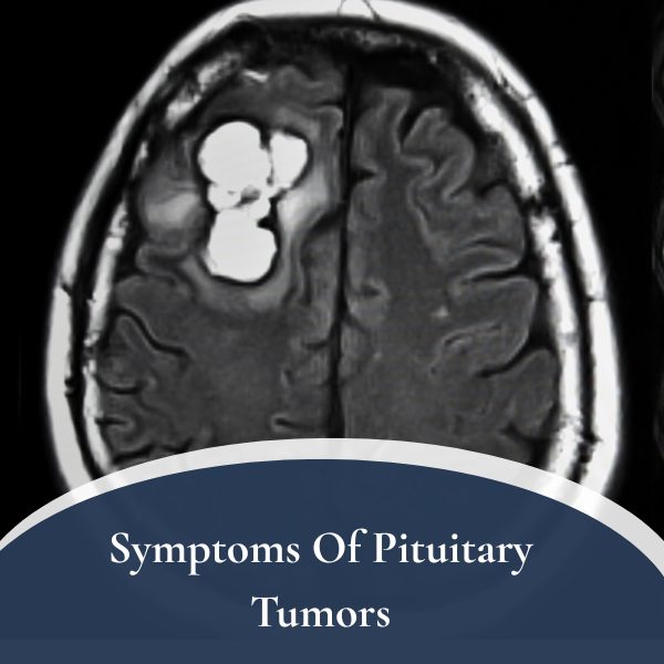 Symptoms Of Pituitary Tumors 1
