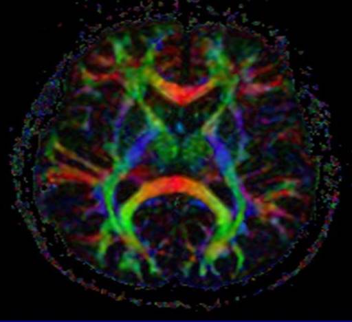 Tractography-1 Tractography 1