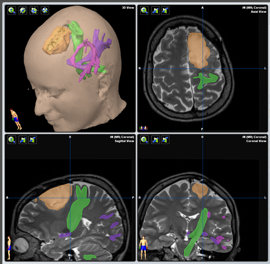 Tractography-2 Tractography 2