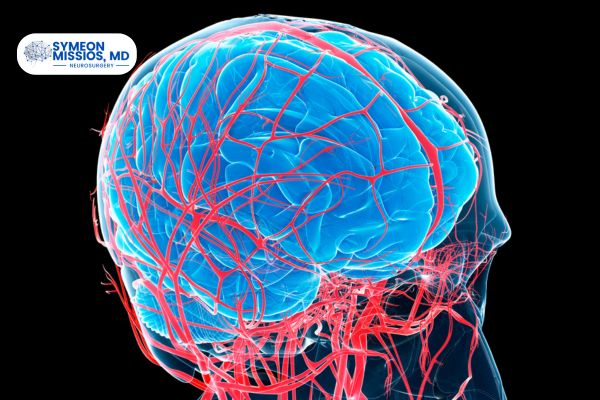 Tumor Embolization (1)
