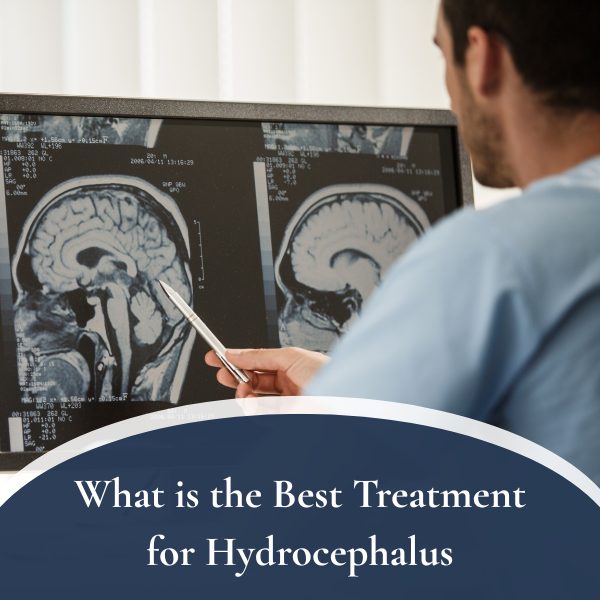 What is the Best Treatment for Hydrocephalus
